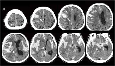 Cerebral Amyloid Angiopathy Presenting as Massive Subarachnoid Haemorrhage: A Case Study and Review of Literature